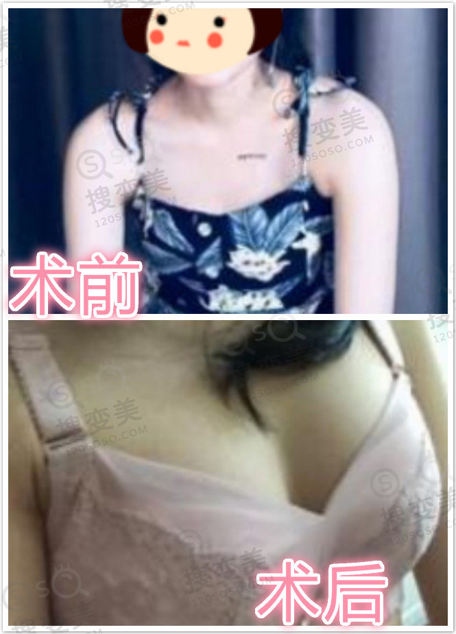 福州爱美尔张胜利自体脂肪丰胸