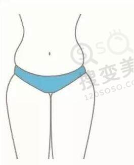 吸脂