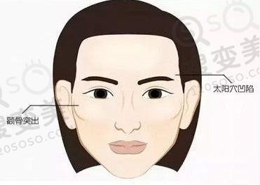 颧骨突出