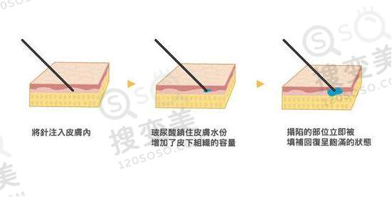 玻尿酸除皱