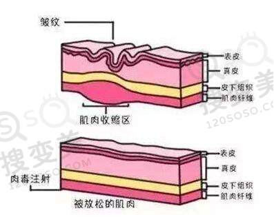 除皱瘦脸除皱
