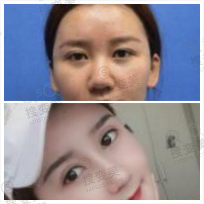 福州美贝尔赵栋材隆鼻病例