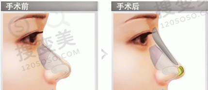 长春珍妮隆鼻技术好不好?