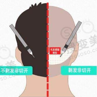 不剃发植发