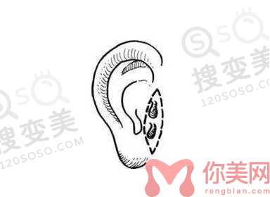 耳部整形医院哪家好
