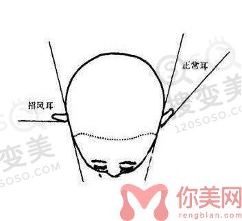 成都招风耳矫正多少钱？