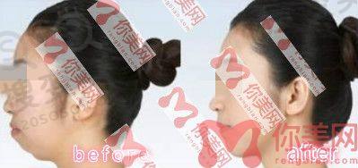 重庆军科凸嘴矫正前后对比图