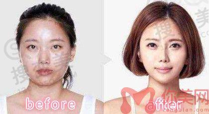 磨骨前后对比图2