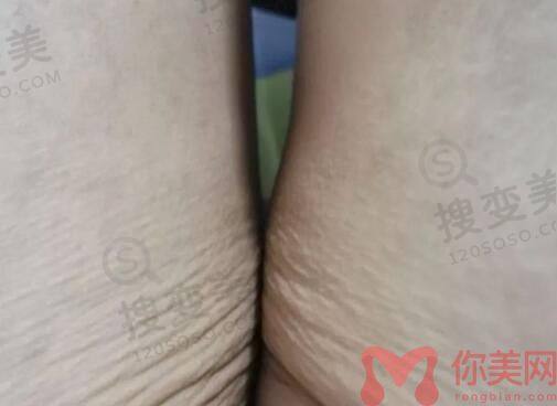 吸脂
