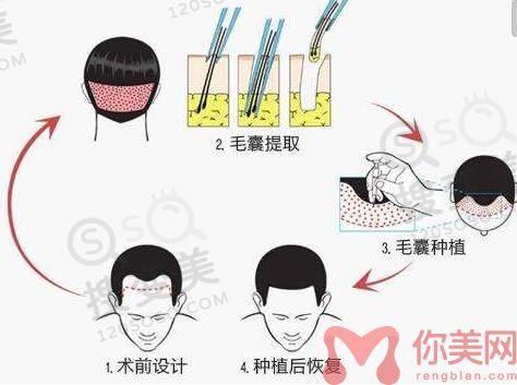 植发的价格一般是多少？