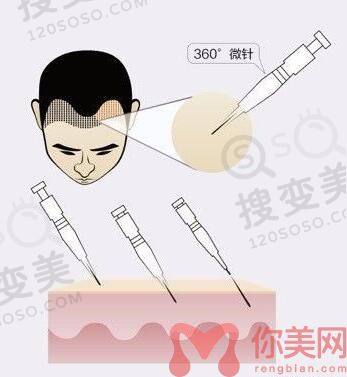 微针植发