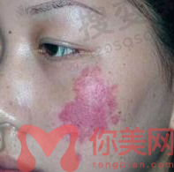 成都军大吴敏去红胎记怎么样？