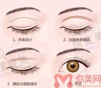 长沙雅美谁做双眼皮比较好？