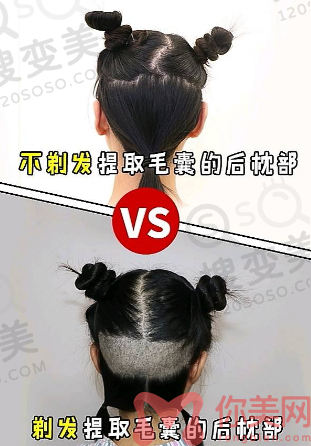 不剃发植发和剃发植发的区别