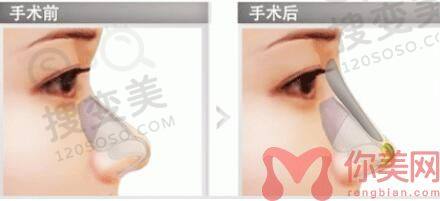 隆鼻