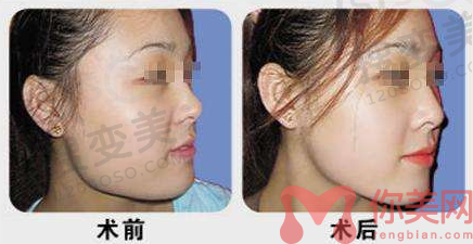 下颌角整形前后对比图