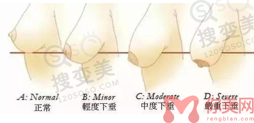 乳房下垂