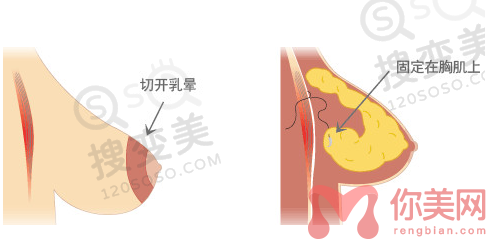 乳房下垂矫正