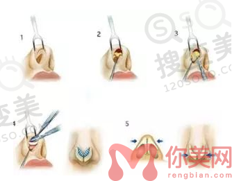 北京隆鼻哪里比较好？