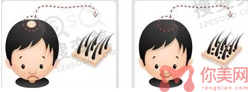合肥植发医院哪家好？
