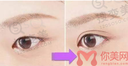 福州双眼皮哪个医生做的好？