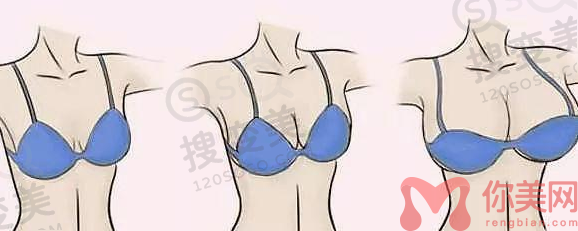 广州假体隆胸价格多少?