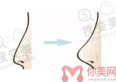 长沙隆鼻哪个医生好？