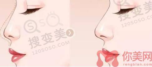 兰州韩美隆鼻好的医生有哪些？