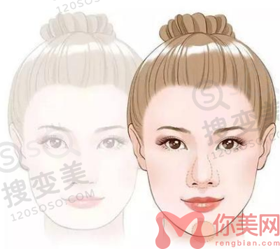 下巴修复需要多少钱?