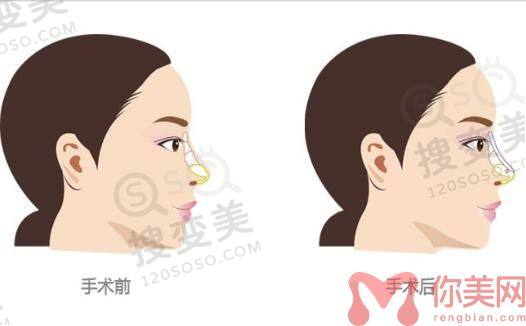 长沙爱思特隆鼻哪位医生做的好？