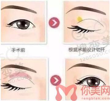 双眼皮