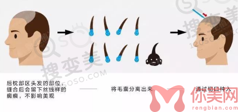 河南那家植发医院好