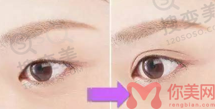 双眼皮前后对比图