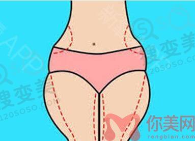 吸脂