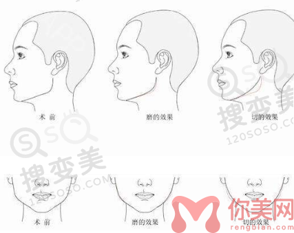下颌角整形是**的吗?