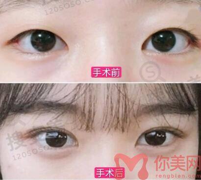 双眼皮