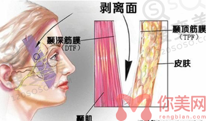 拉皮除皱
