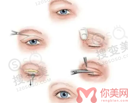 双眼皮