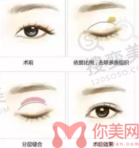 双眼皮 