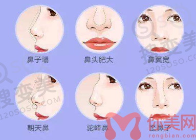 隆鼻