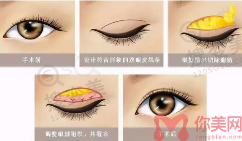 双眼皮