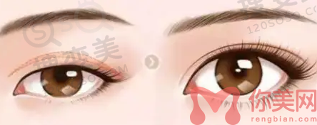 双眼皮修复