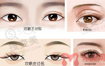 双眼皮修复
