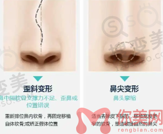 鼻修复