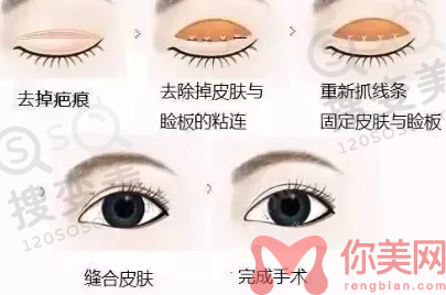 双眼皮修复