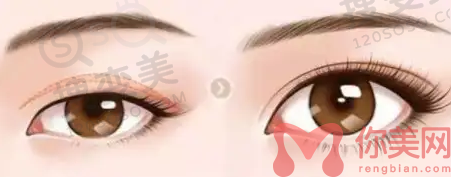 双眼皮修复