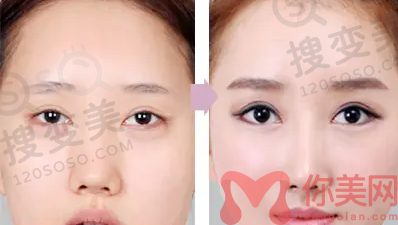 双眼皮修复