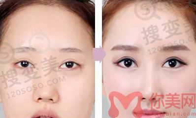 双眼皮修复