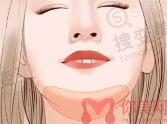 下巴吸脂