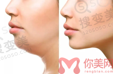 下巴吸脂